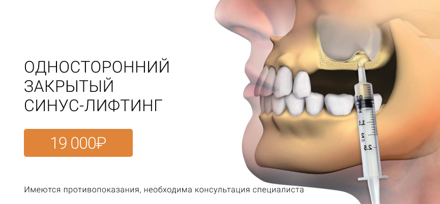Синуслифтинг закрытый Пушкин