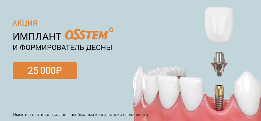 Имплант Osstem Южная Корея Пушкин